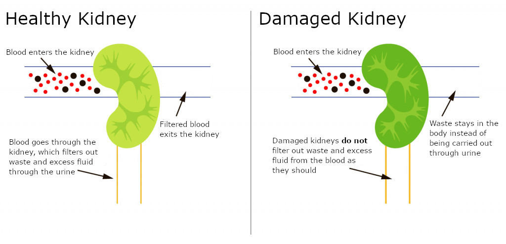 Learn More About Kidney Disease DialysisReadyDialysisReady learn-more-about-kidney-disease-dialysisreadydialysisready